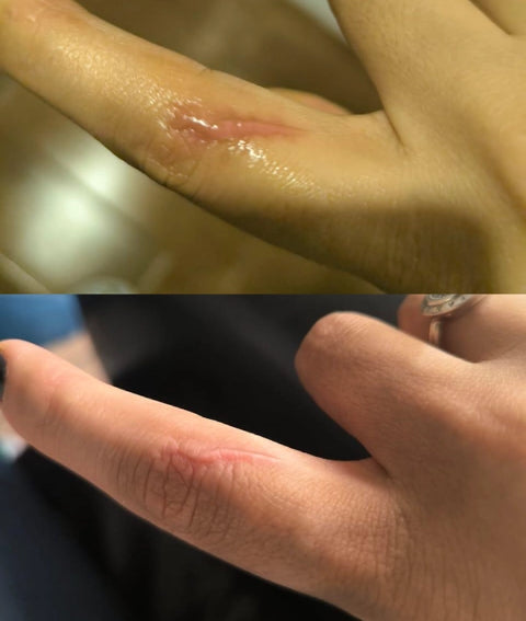 Antes y después de cicatriz en dedo índice