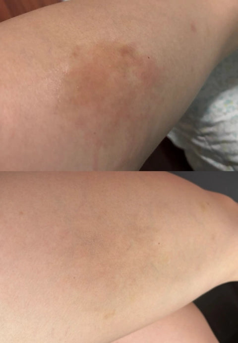 Antes y después de mancha en un muslo