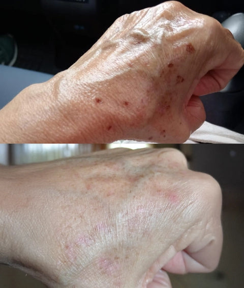 Manchas en la piel antes y después