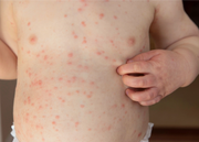 Primer plano del abdomen de un bebé con la piel irritada