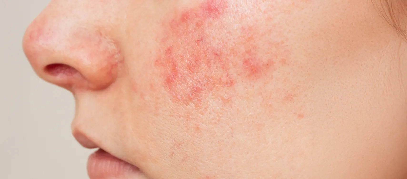 Rostro de perfil con rosacea