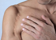 Cicatriz en el hombro de un hombre