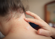 Primer plano de la piel en el cuello con dermatitis