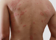 Espalda con manchas rojas