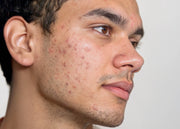 Rostro de un hombre con acné