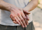 Manos con dermatitis