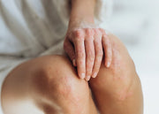 Manos y piernas con psioriasis