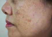 Primer plano del rostro de una mujer con manchas