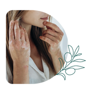 Mujer con cicatrices en las manos